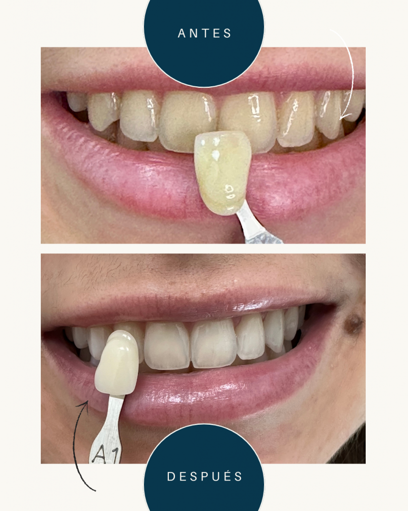Fotos del blanqueamiento dental realiazo a un paciente en la clínica dnetal Lorenzo Cáceres