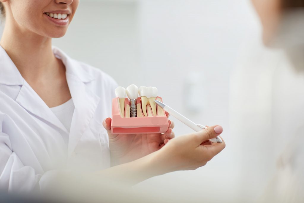 imagen de un doctor sujetando una estructura de implantes dentales